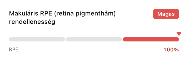 Makuláris RPE rendellenesség — Magas